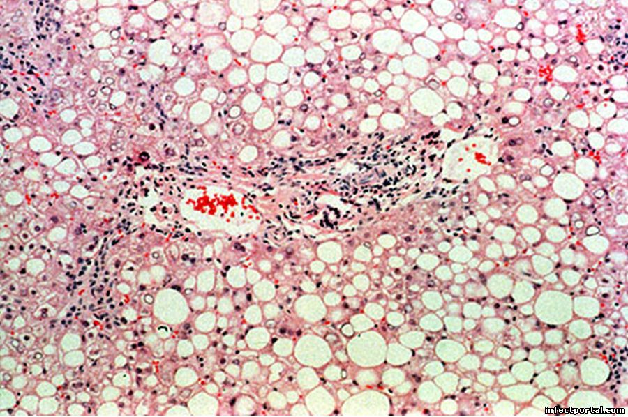 Жировая дистрофия печени (тяжелая степень) при хроническом гепатите